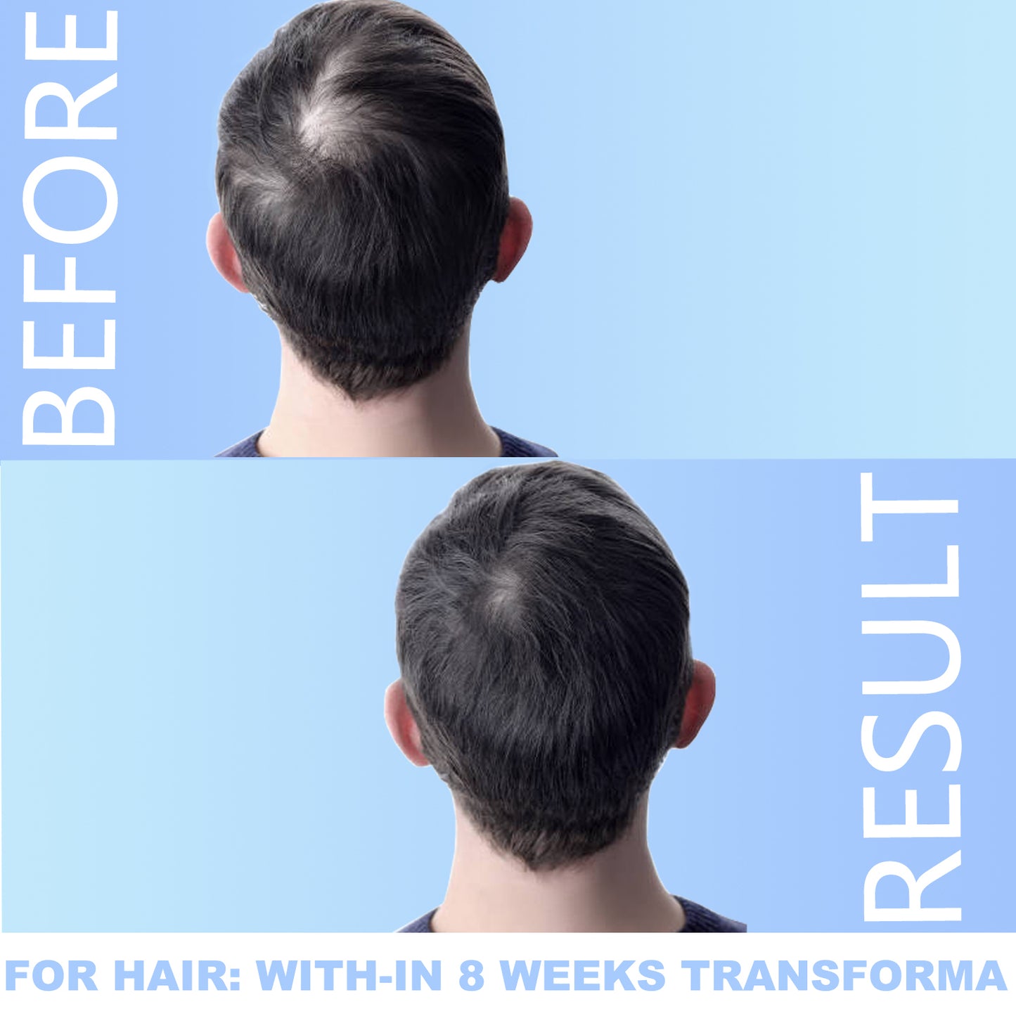 Derma Roller 540 Titanium Microneedling Roller